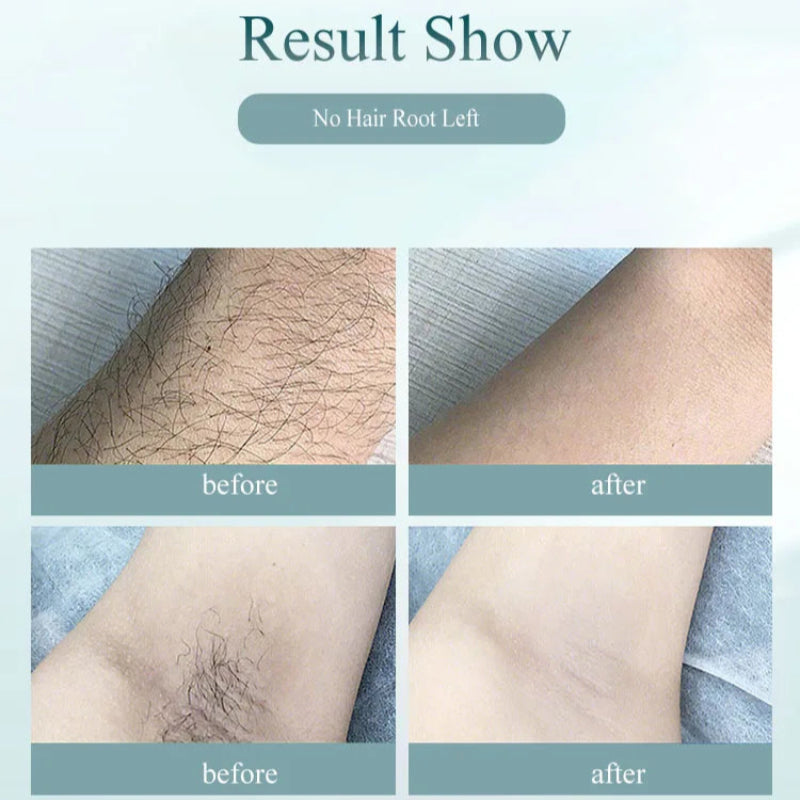Depilador a Laser IPL Permanente 900.000 Flashes - Depilação Indolor, Casa, Corpo Inteiro
